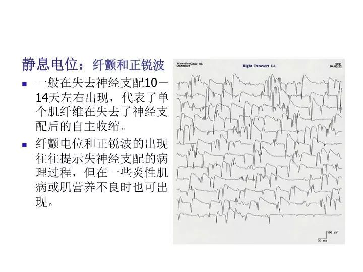 臨床筆記|一文讀懂:肌電圖的機制和應用基礎_騰訊新聞