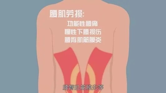 背肌筋膜炎位置图片图片