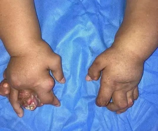 包括臀部,耳廓等多个部位,双手关节因被痛风石侵占逐渐变形,活活变成