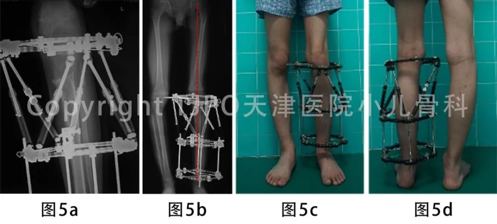 tjpo儿童矫形科普(8—泰勒外固定支架逐渐矫正胫骨近端内翻伴短缩