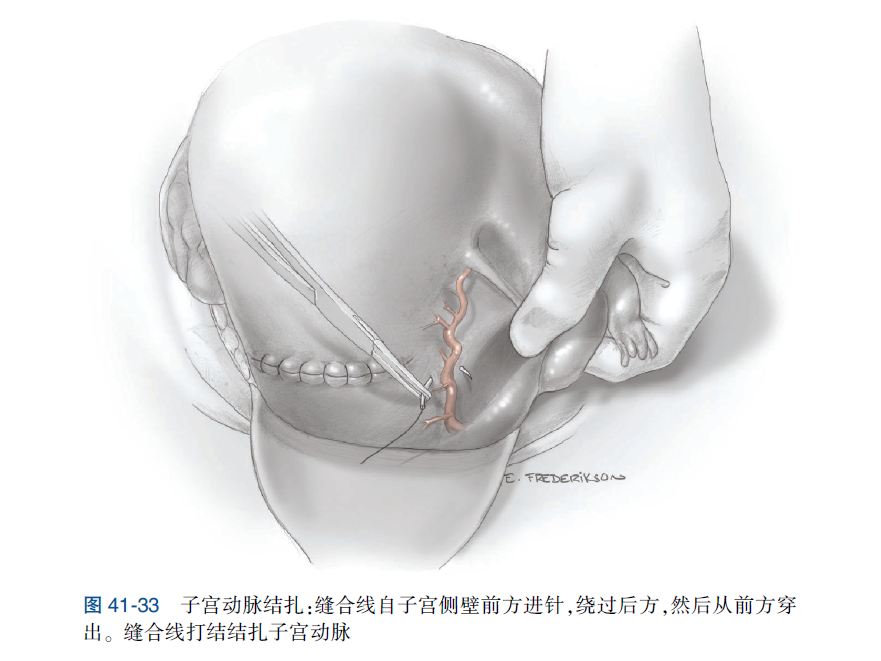 子宫动脉结扎术1外科止血04图 3  来源:《威廉姆斯产科学,第 25 版》