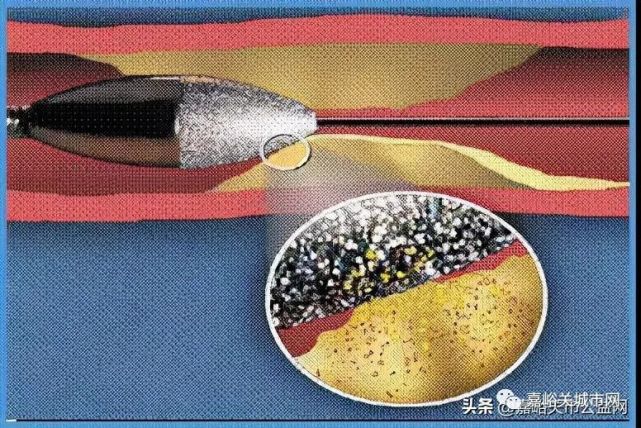 酒钢医院心血管科成功开展河西首例高龄患者冠状动脉内旋磨术