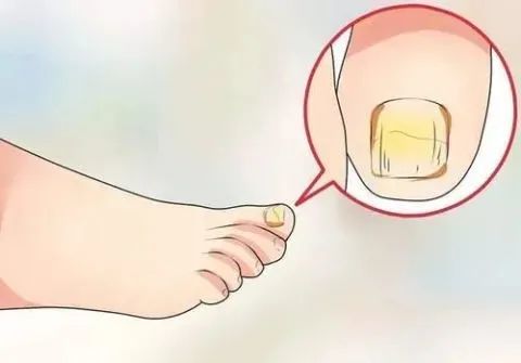 交大二附院教你灰指甲如何能亮甲