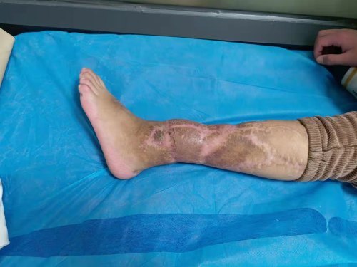 11岁男童3年前被砖墙砸断小腿常德骨科医院精心接力治疗修复如初