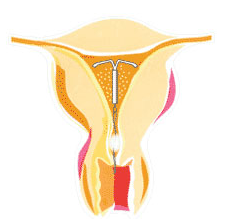 节育环是一种放置在子宫腔内的避孕装置由于初期使用的装置多是环状的