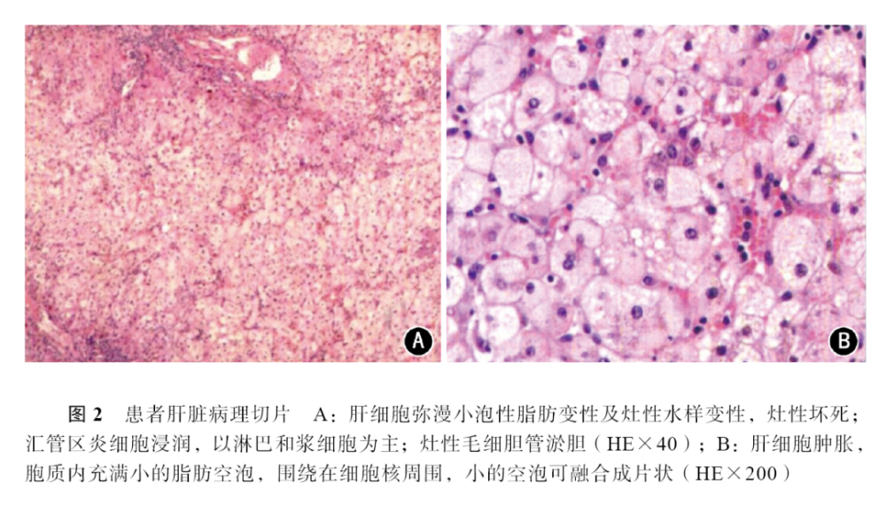 手术顺利,术后病肝病理回报:肝细胞弥漫小泡性脂肪变性及灶性水样变性