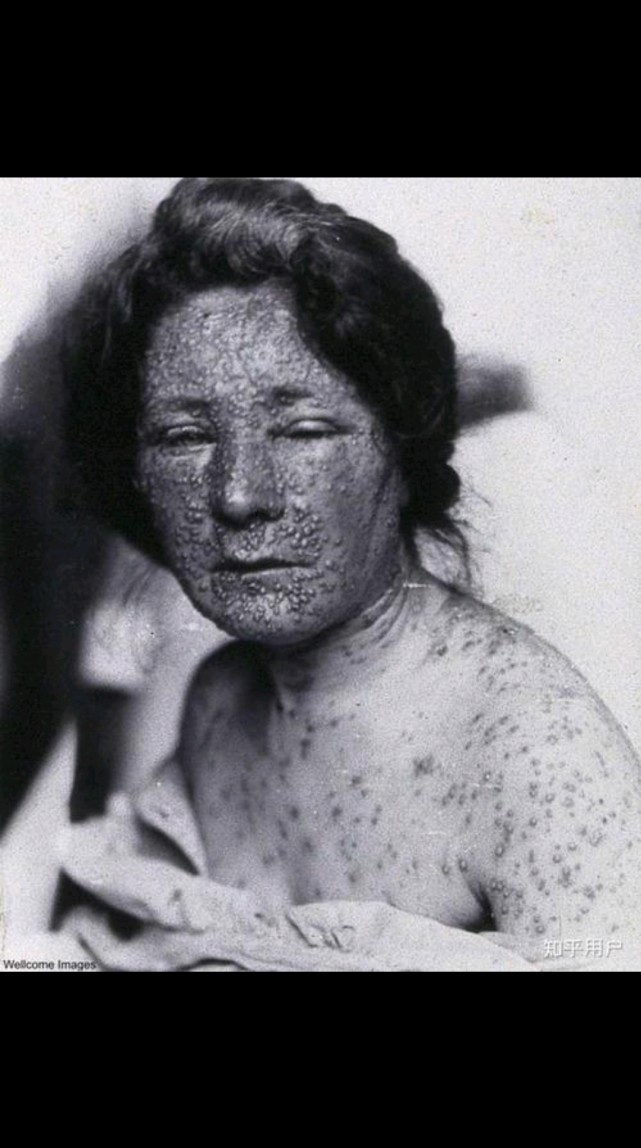 黑死病到底有多恐怖