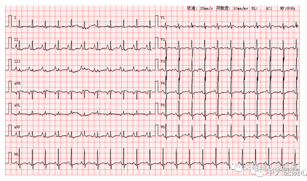 每日读图|第1579期 急性广泛前壁心肌梗死_腾讯新闻