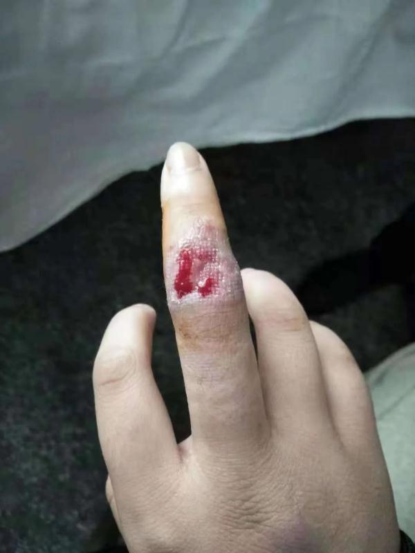 女孩子手指受伤的照片图片