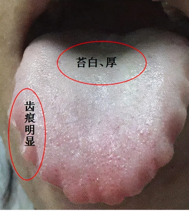 齒痕舌,脾虛溼盛的標誌?送你四味藥食同源的中藥,長期堅持消齒印