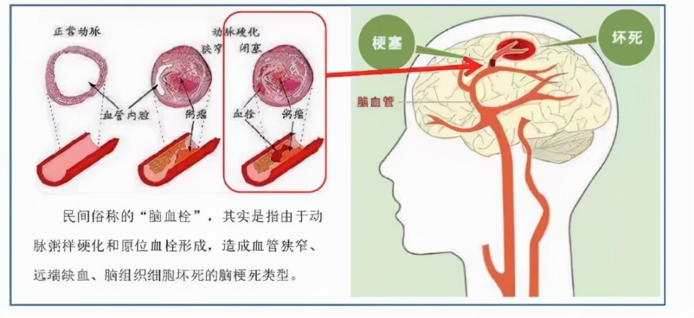 脑梗遗传图片