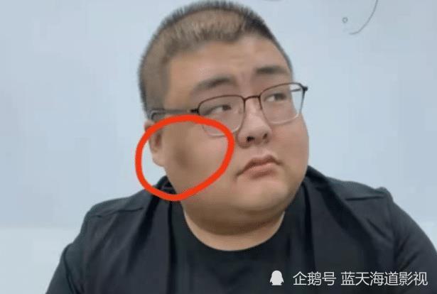 泡泡龙悲剧再上演胖猴仔近照曝光说话大喘气脸上黑斑明显