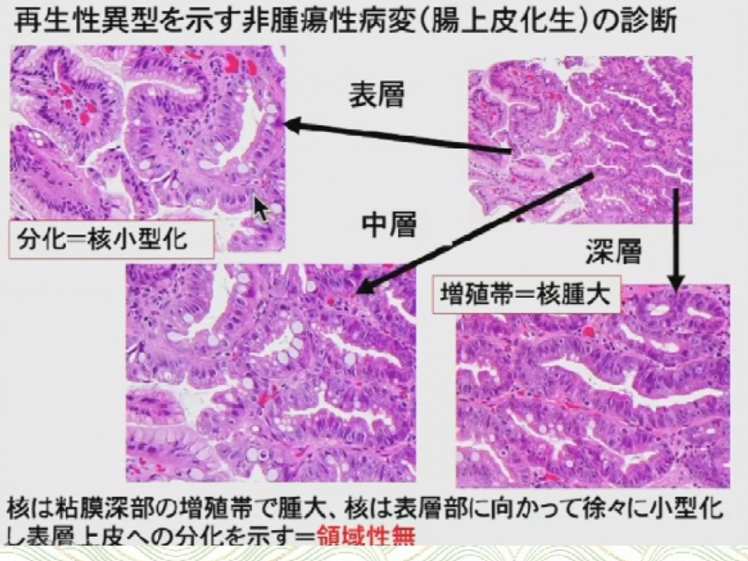 早期胃癌病理診斷:who vs 日本標準,一文解析_騰訊新聞