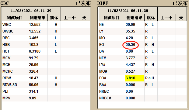 患者的血常規白細胞分類很不正常,嗜酸性粒細胞百分之三十多,散點圖亂