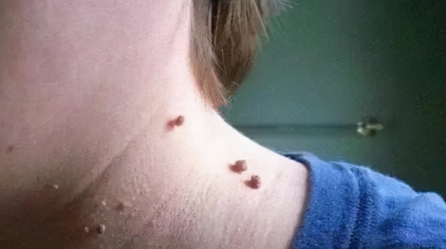 接种了hpv疫苗就不会感染了身体出现3个表现应当多留意