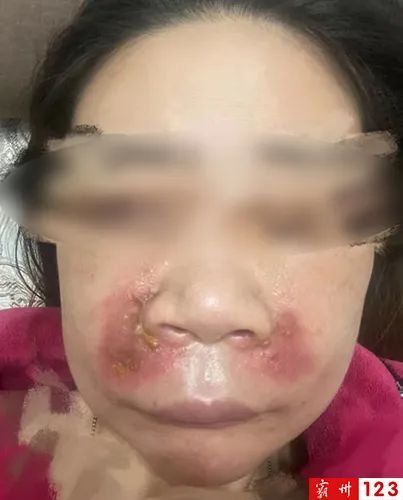 我问给我媳妇用的什么东西,拿给我看看,她说玻尿酸早就没有了,溶解酶