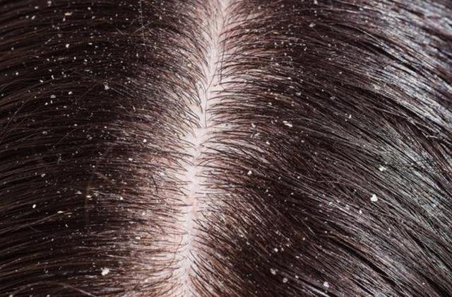 头发根部的小白点是什么?掉了不能长出头发?