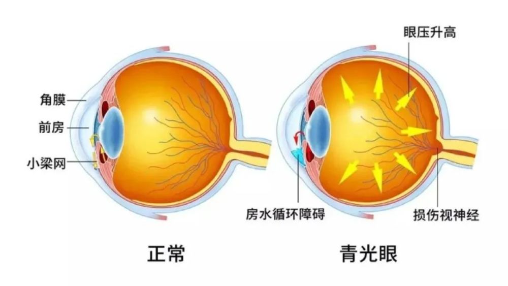 糖網病,黃斑變性,視網膜脫離等. 什麼是糖網病?