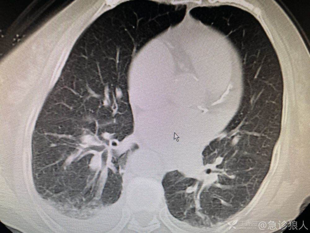 胸部 ct:雙肺慢性炎顱腦 ct:腦白質脫髓鞘改變,腦萎縮;神經內科會診