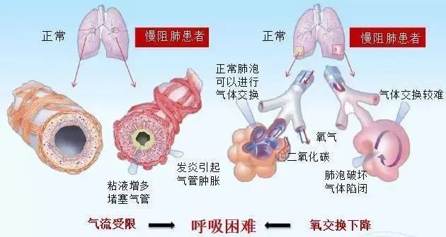 疾控話健康共抗慢阻肺