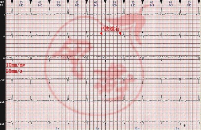 心電圖圖例分析20:交界性逸搏心律,左心室肥大