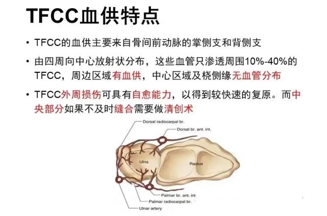 腕關節鏡微創手術治療:關節鏡下修復tfcc,優勢在於組織剝離少,粘連少