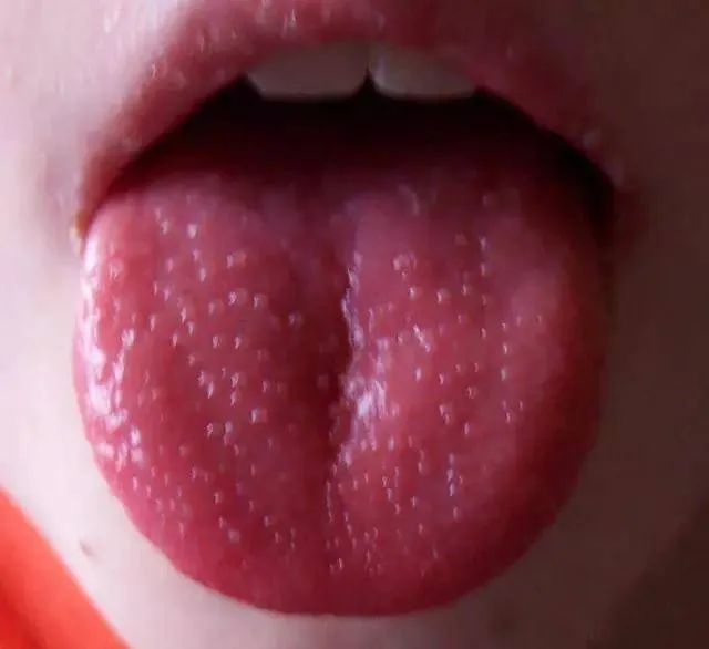 草莓舌(肺热,经常发烧)草莓舌: 湿热舌质淡红,舌体铺满小红点,与草莓