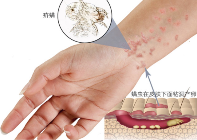 皮防科普丨一人感染 全家遭殃的疥疮|疥疮|皮肤|疥螨|寄生虫|人民卫生