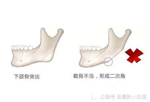 只針對下頜角部位的截骨手術,截骨線短,直,截下的骨塊多為三角形,對