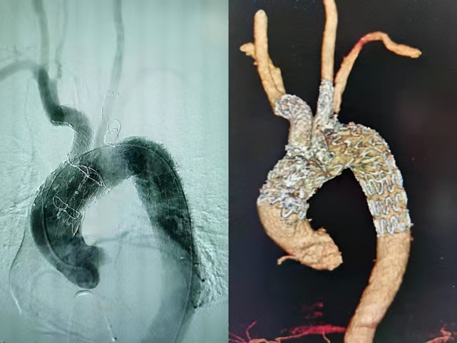 中南地区首例湘雅医院成功完成升主动脉模块内嵌支架手术