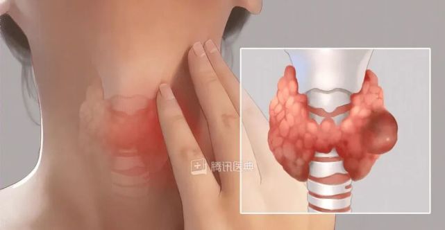 甲状腺分级到底是什么?