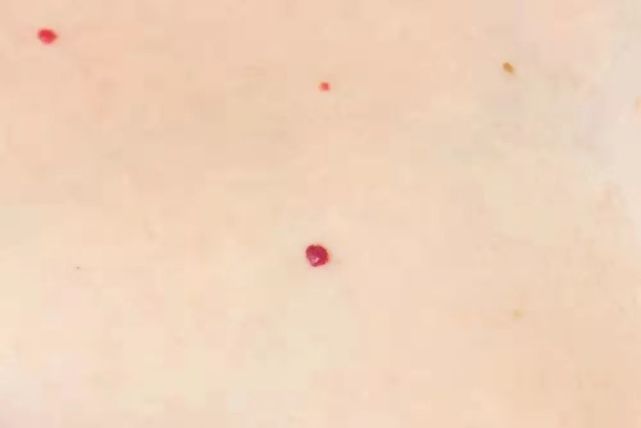 血管痣怎么就患上老人病了?可明明才20多岁的人被告知是老年血管