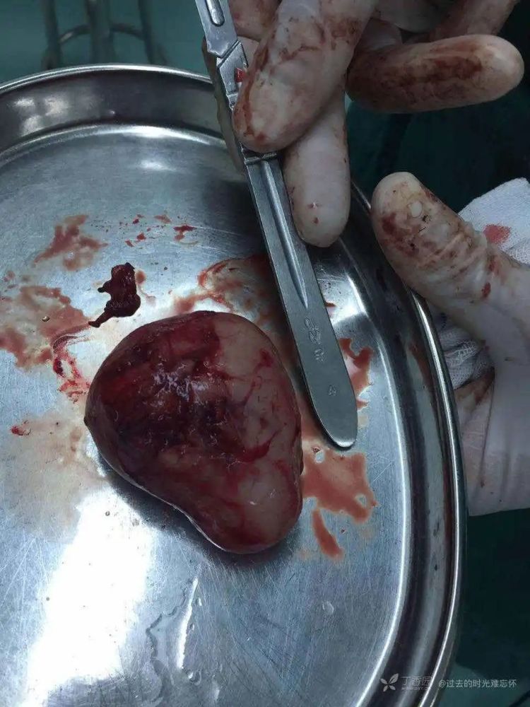 年轻女孩腋下现"鸡蛋大"肿物,究竟是什么?