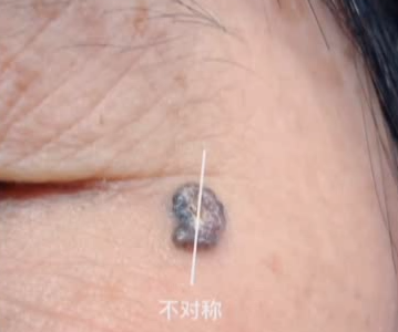因为脚底一颗小 黑痣 广东一女子摊上大事了 腾讯新闻