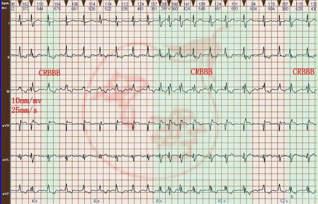 心电图图例分析21:心房颤动,不完全性右束支阻滞,间歇性完全性右束支