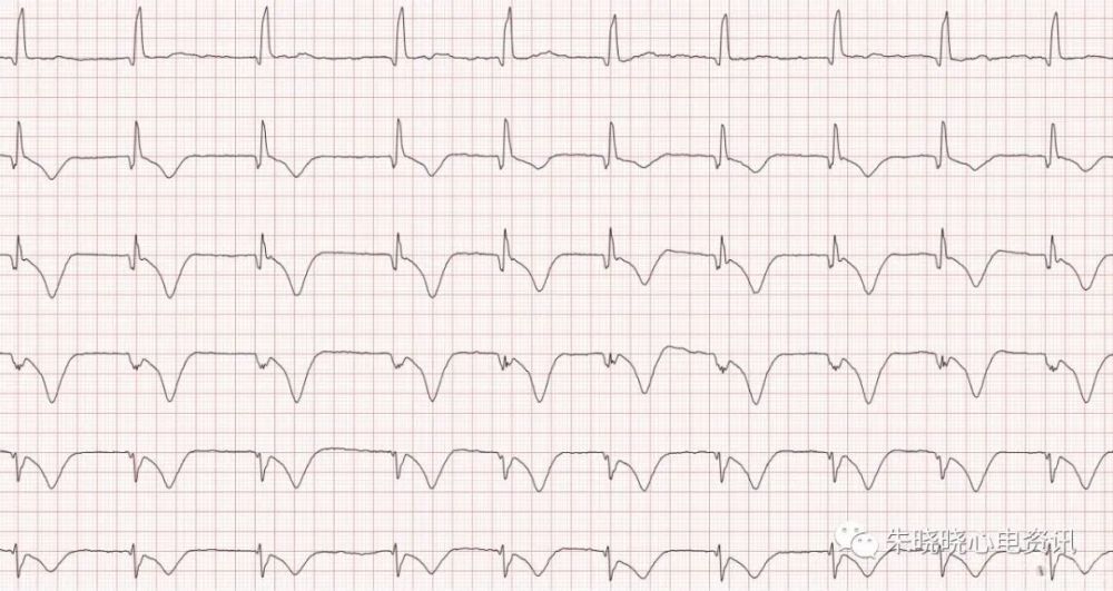 深大倒置t波的诊断与鉴别诊断_腾讯新闻