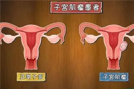 比如说子宫内膜息肉,子宫腺肌症,子宫肌瘤还有子宫内膜增生或者是癌变