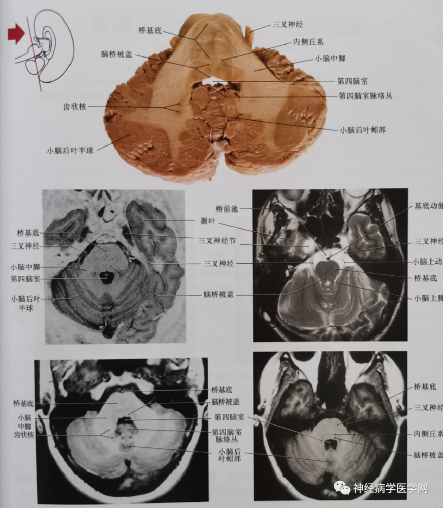 臨床神經解剖圖譜斷層影像切片