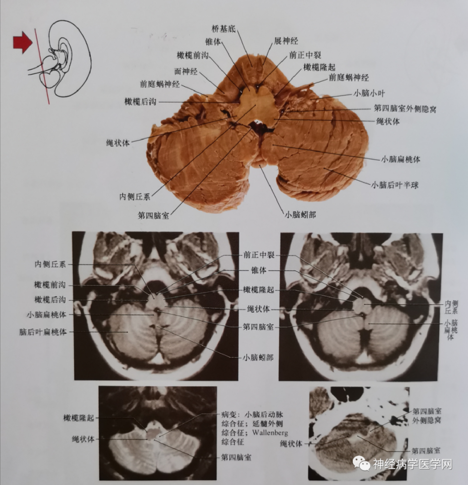 注意並列的小腦扁桃體和髓質.