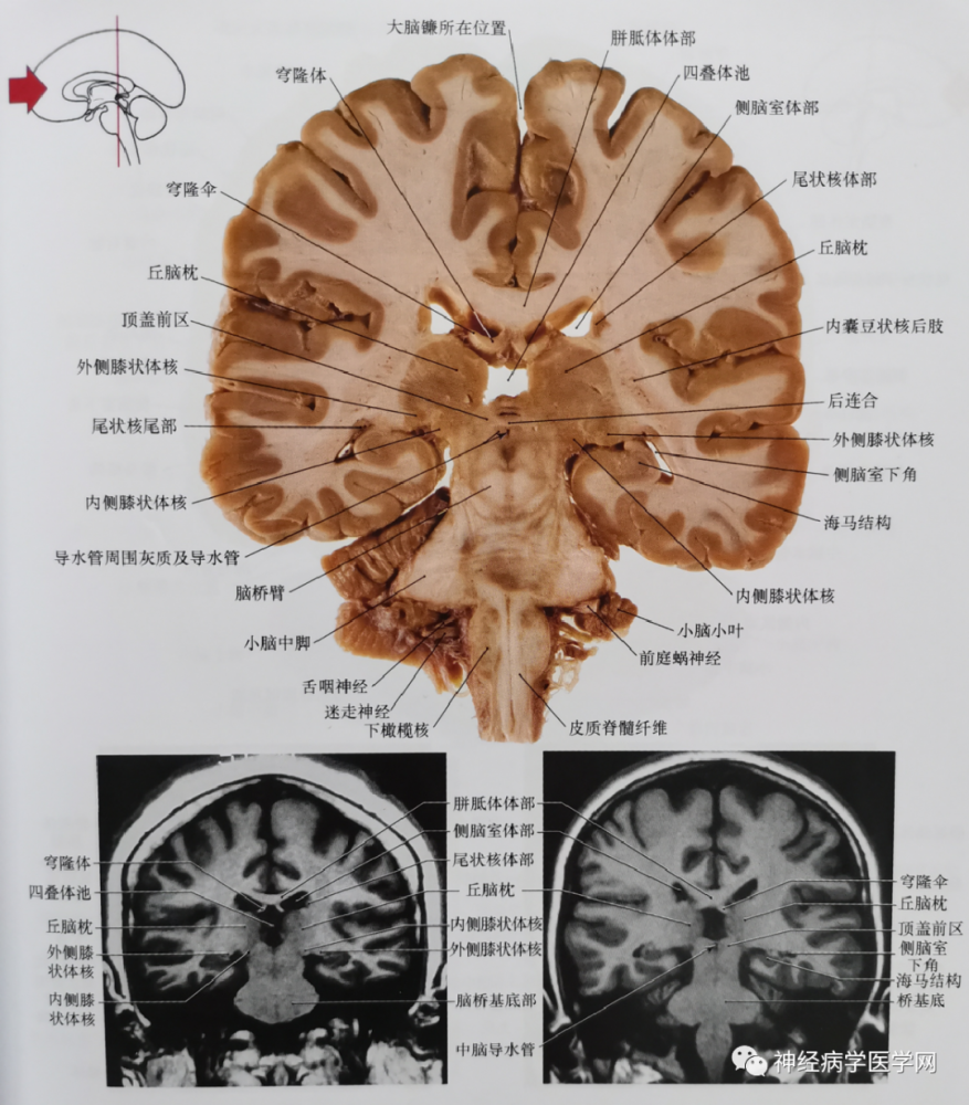 臨床神經解剖圖譜斷層影像切片