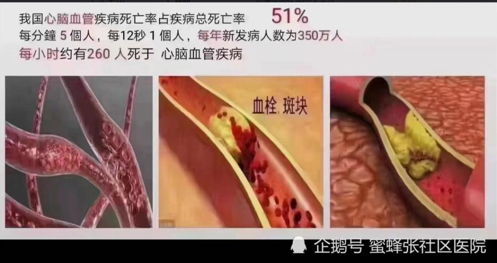 心脑血管疾病死亡率51血液垃圾是什么