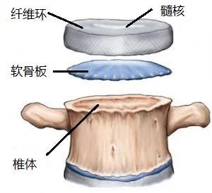 椎體終板炎發生機制分型以及mri表現