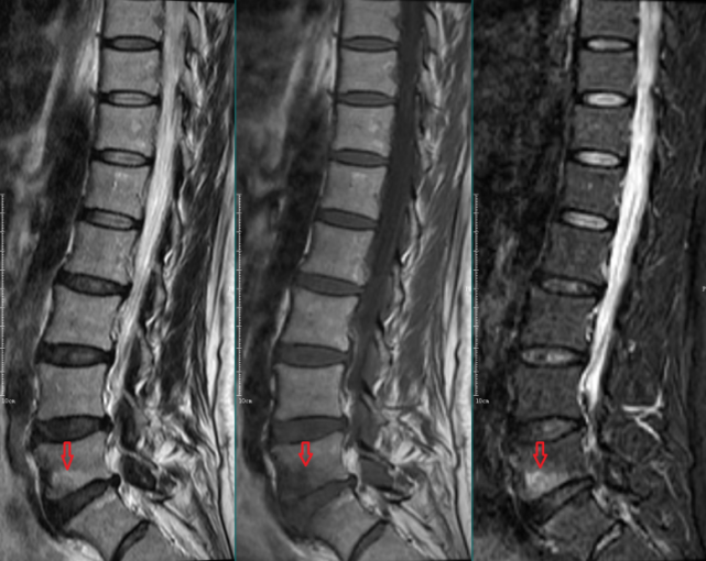 椎体终板炎|发生机制,分型以及 mri 表现