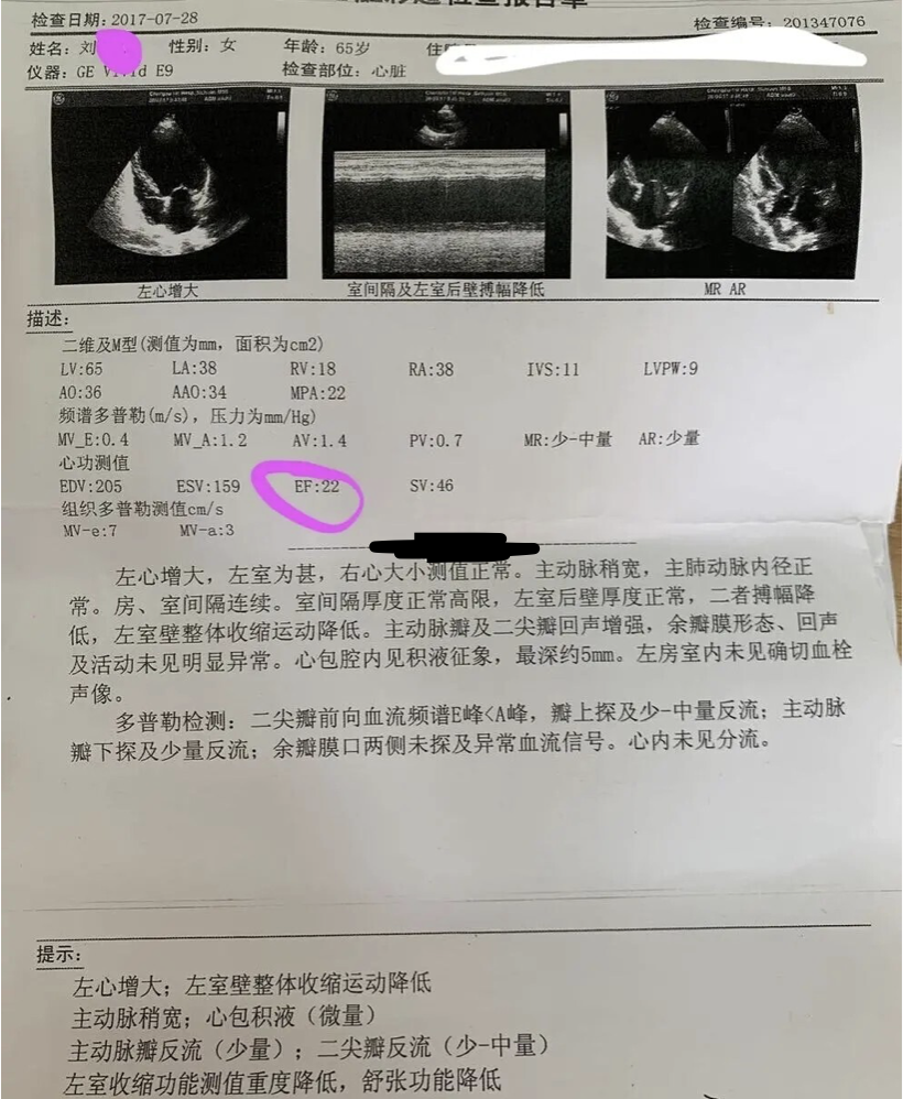 到当地医院看病,心脏彩超:左心大,lvef 33%(反映左心室泵血能力的指标