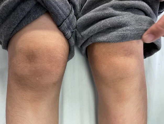 福州一男孩老说膝盖疼,一查竟是…很多家长忽视!