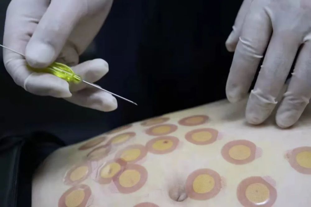 李洋中医穴位埋线长效复合疗法治疗疑难病临床应用精品推广班