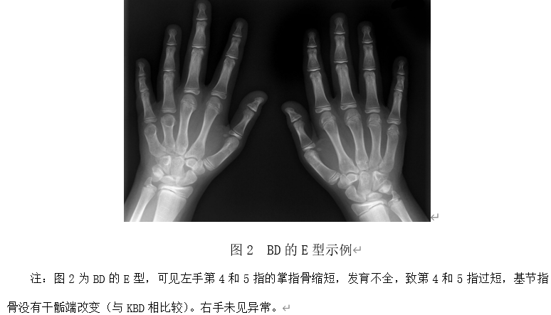 儿童大骨节病与先天性短指畸形的鉴别