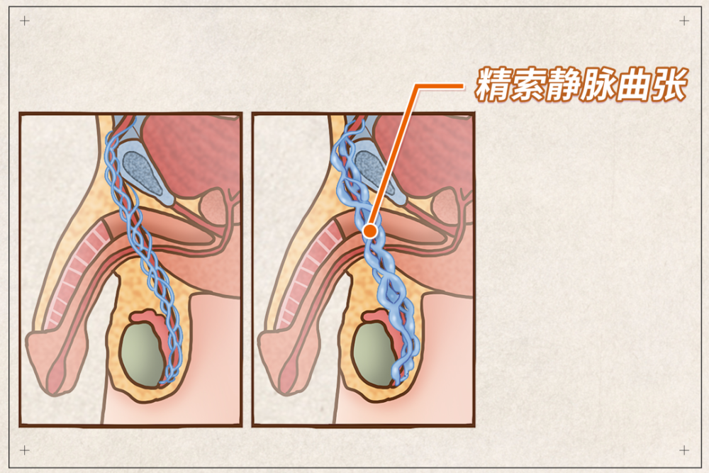 精索静脉回流障碍,可能由于静脉壁发育障碍,静脉瓣功能不良等先天发育