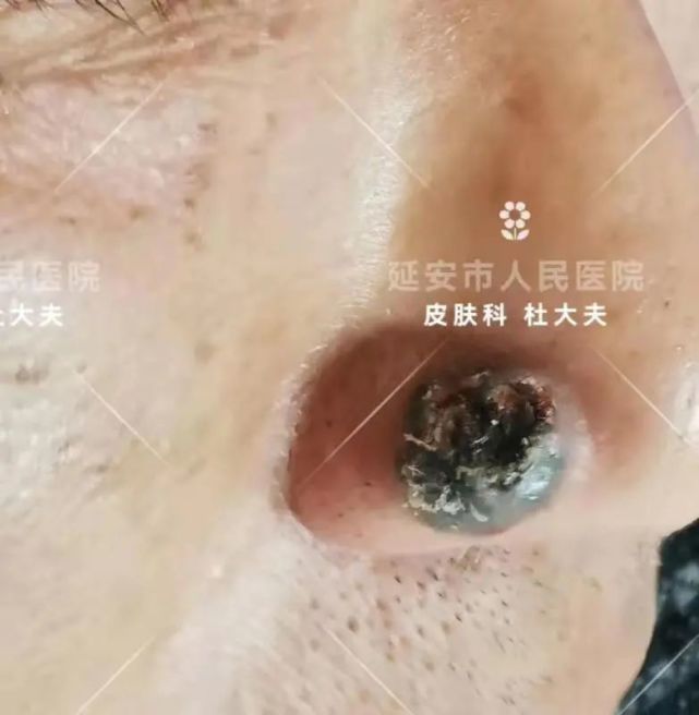 警惕这种斑块不是老年斑是癌