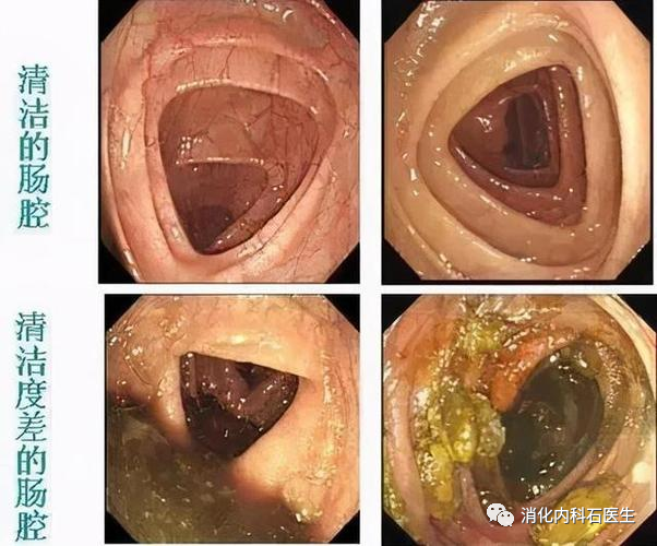 腸鏡檢查發現結腸息肉3個做手術時卻發現5個為什麼